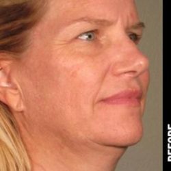 Ultherapy Before & After Patient #1559